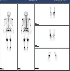 Figura 1. Gammagrafía ósea. Asimetría de la captación del radiofármaco entre los tobillos. El depósito es más intenso en el tobillo izquierdo, lo que sugiere la presencia de osteomielitis